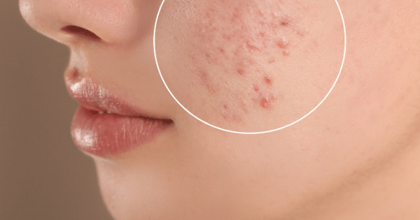 How To Combat Acne in Bangalore's Hot and Humid Climate