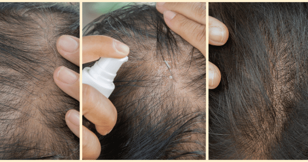 7 Surprising Tips to Boost Hair Growth Naturally: Insider Secrets for BTM Layout Locals