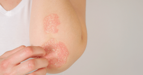 Coping with Eczema and Psoriasis: Skincare Tips for Bangalore Women