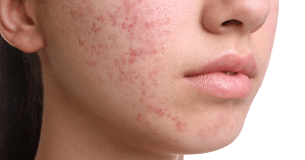 Treating Hormonal Acne: Bangalore's Holistic Approach