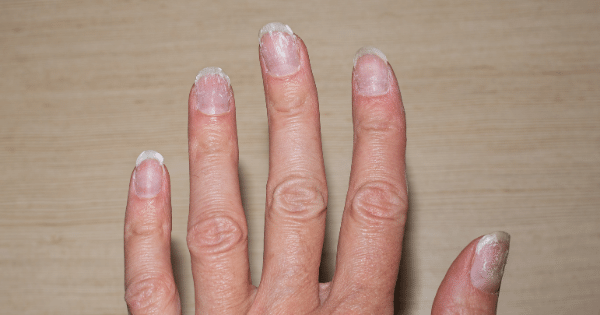 Smart Strategies To Repair Damaged Nails in Bangalore