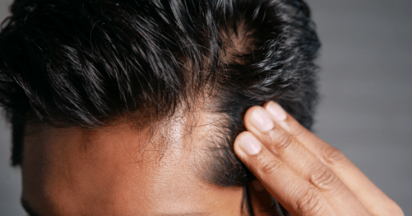 Men's Hair Care: Bangalore's Guide to Treating Ingrown Hairs