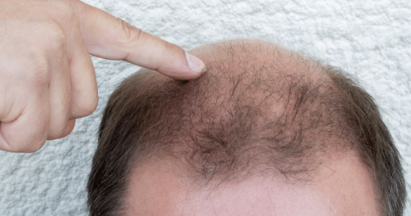 Men's Hair Care: Bangalore's Essentials for Dealing with Hair Loss