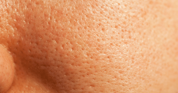 Tips for Minimizing Pores in Bangalore's Humid Climate