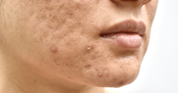 How To Treat Acne Breakouts in Bangalore