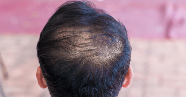 Men's Hair Care: Bangalore's Insights into Hair Thinning Solutions