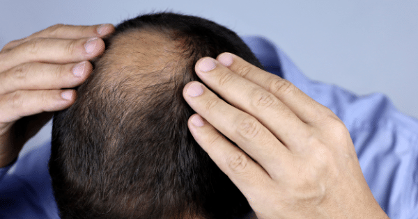 Men's Hair Care: Bangalore's Guide to Hair Care for Balding Men